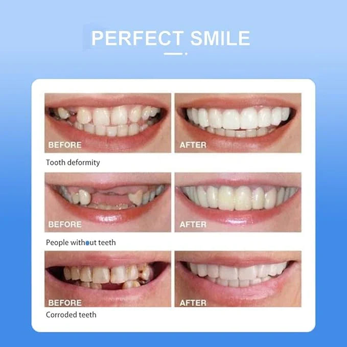 Removable White Teeth Veneers Covers Gaps, Yellow, Missing & Crooked Teeth - One Size Fits All, No Dentist Needed
